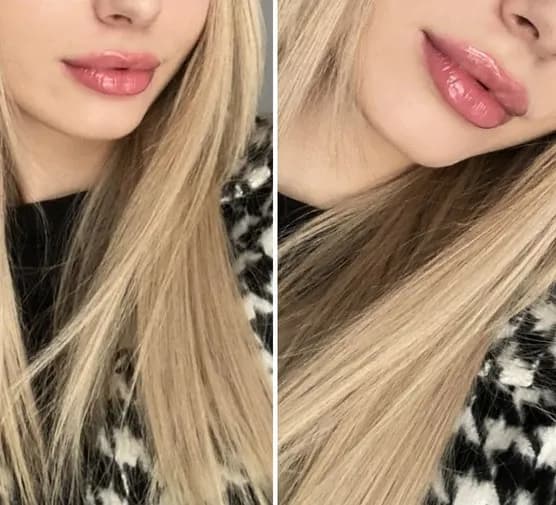 Ile po powiększaniu ust nie można pić alkoholu, aby uniknąć komplikacji?