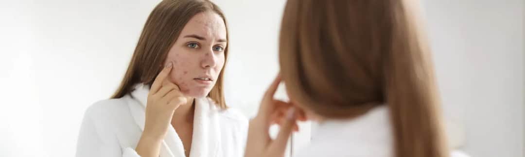 Krem do cery suchej z wypryskami – jak uniknąć podrażnień?