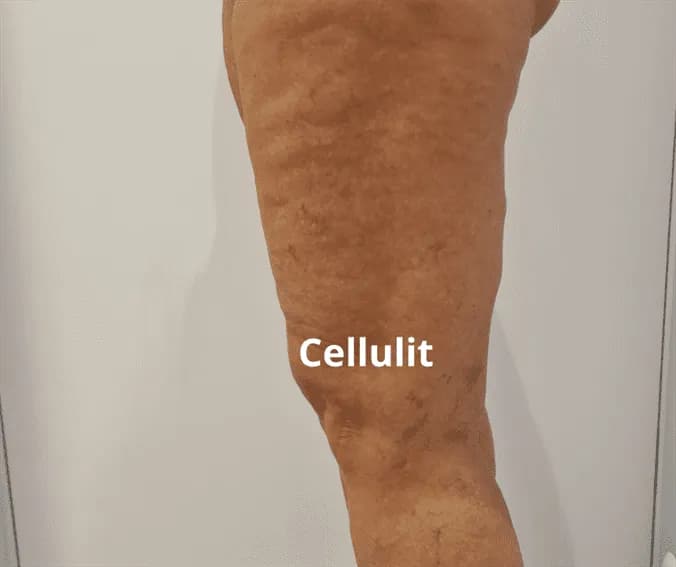 Co wam pomogło na cellulit? Skuteczne metody, które działają